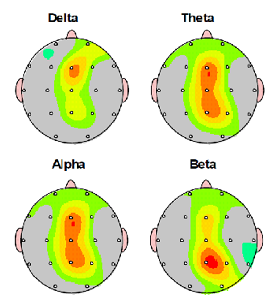 Neurofeedback bij autisme - QEEG