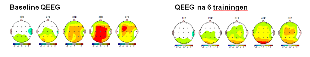 QEEG effectmeting